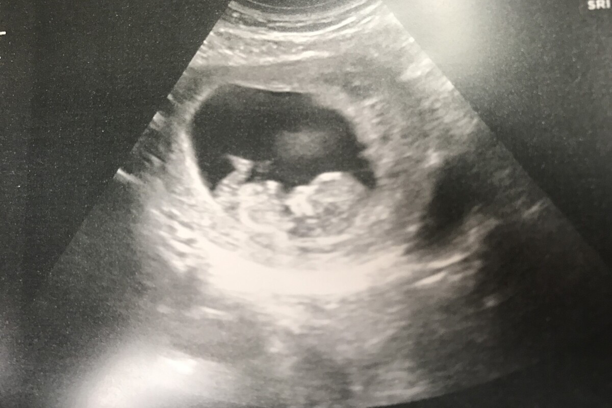 A picture of an ultrasound